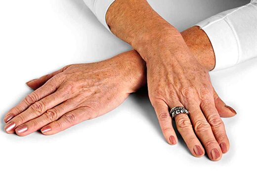 Шкіра рук із віковими змінами, що вимагає використання методик з омолодження
