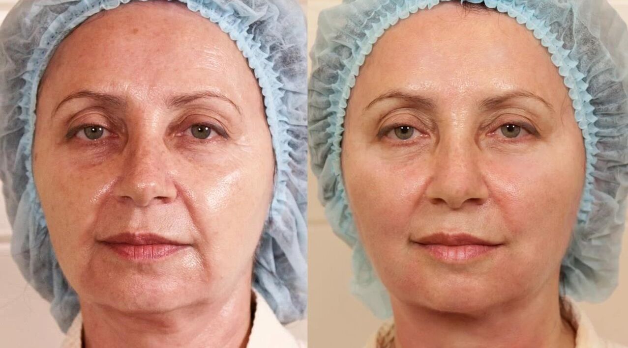 фото до та після підтяжки шкіри обличчя
