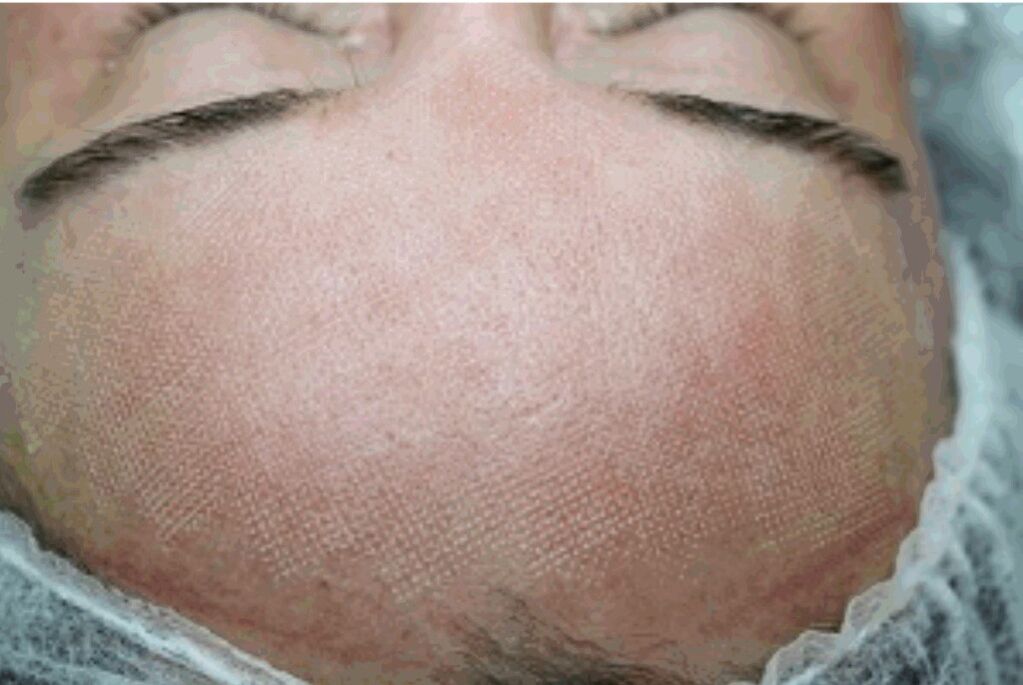 Почервоніння і легка набряклість шкіри після фракційного лазера